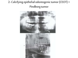 2- Calcifyingepithelial odontogenictumor (CEOT)=
Pindborgtumor
 