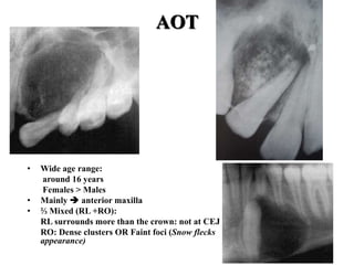 AOT
• Wide age range:
around 16 years
Females > Males
• Mainly  anterior maxilla
• ⅔ Mixed (RL +RO):
RL surrounds more than the crown: not at CEJ
RO: Dense clusters OR Faint foci (Snow flecks
appearance)
 