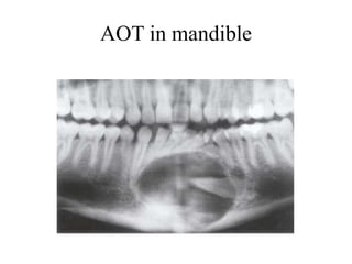 AOT in mandible
 