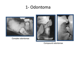 1- Odontoma
Complex odontomas
Compound odontomas
 