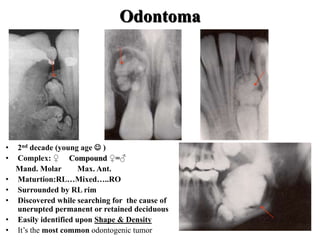 Odontoma
• 2nd decade (young age  )
• Complex: ♀ Compound ♀=♂
Mand. Molar Max. Ant.
• Maturtion:RL…Mixed…..RO
• Surrounded by RL rim
• Discovered while searching for the cause of
unerupted permanent or retained deciduous
• Easily identified upon Shape & Density
• It’s the most common odontogenic tumor
 