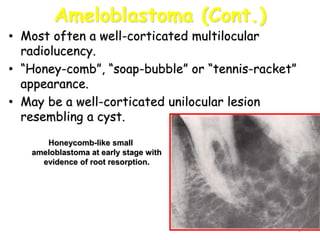 7
Ameloblastoma (Cont.)
• Most often a well-corticated multilocular
radiolucency.
• “Honey-comb”, “soap-bubble” or “tennis-racket”
appearance.
• May be a well-corticated unilocular lesion
resembling a cyst.
Honeycomb-like small
ameloblastoma at early stage with
evidence of root resorption.
 