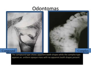 Odontomas
The compound type shows apparent tooth shapes while the complex type
appears as uniform opaque mass with no apparent tooth shapes present
Compound Complex
 