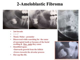 2-Ameloblastic Fibroma
• 2nd decade
• ♀ = ♂
• Mand. Molar - premolar
• Discovered while searching for the cause
of unerupted tooth or because of the facial
swelling & Occ. pain they cause
• Identified upon:
-Outwards growth from the follicle
-Grows towards the alveolar process
• Hat cap like RL
 