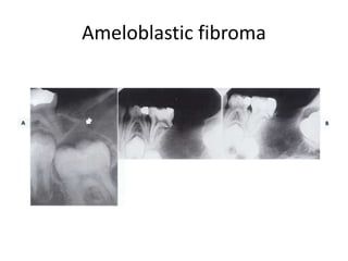 Ameloblastic fibroma
 