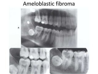 Ameloblastic fibroma
 