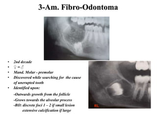 3-Am. Fibro-Odontoma
• 2nd decade
• ♀ = ♂
• Mand. Molar - premolar
• Discovered while searching for the cause
of unerupted tooth
• Identified upon:
-Outwards growth from the follicle
-Grows towards the alveolar process
-RO: discrete foci 1 – 2 if small lesion
extensive calcification if large
40 y, ♂, Not as an outward growth
RL
 