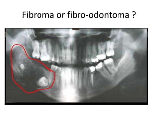 Fibroma or fibro-odontoma ?
 