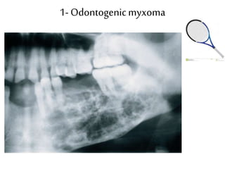 1- Odontogenicmyxoma
 