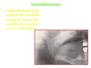 8
Ameloblastoma
• Ameloblastoma at the
angle of the mandible.
• Expansive form with
oval RL traversed by
few very thin septa
 