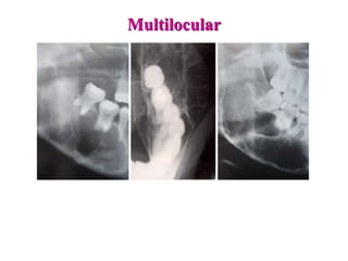 Multilocular
 