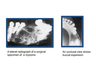 A lateral radiograph of a surgical
specimen of a myxoma
An occlusal view shows
buccal expansion
 