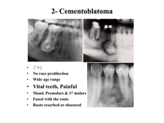 2- Cementoblatoma
• ♂ >♀
• No race predilection
• Wide age range
• Vital teeth, Painful
• Mand. Premolars & 1st molars
• Fused with the roots
• Roots resorbed or obscured
 
