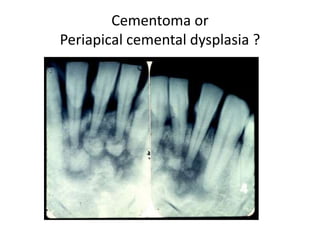 Cementoma or
Periapical cemental dysplasia ?
 