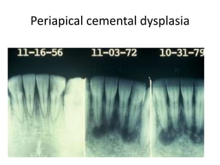 Periapical cemental dysplasia
 