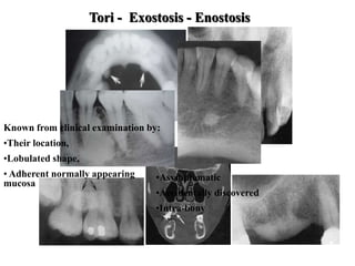 Tori - Exostosis - Enostosis
Known from clinical examination by:
•Their location,
•Lobulated shape,
• Adherent normally appearing
mucosa
•Asymptomatic
•Accidentally discovered
•Intra-bony
 