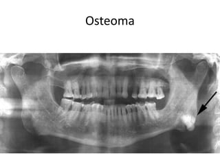 Osteoma
 