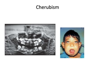 Cherubism
 