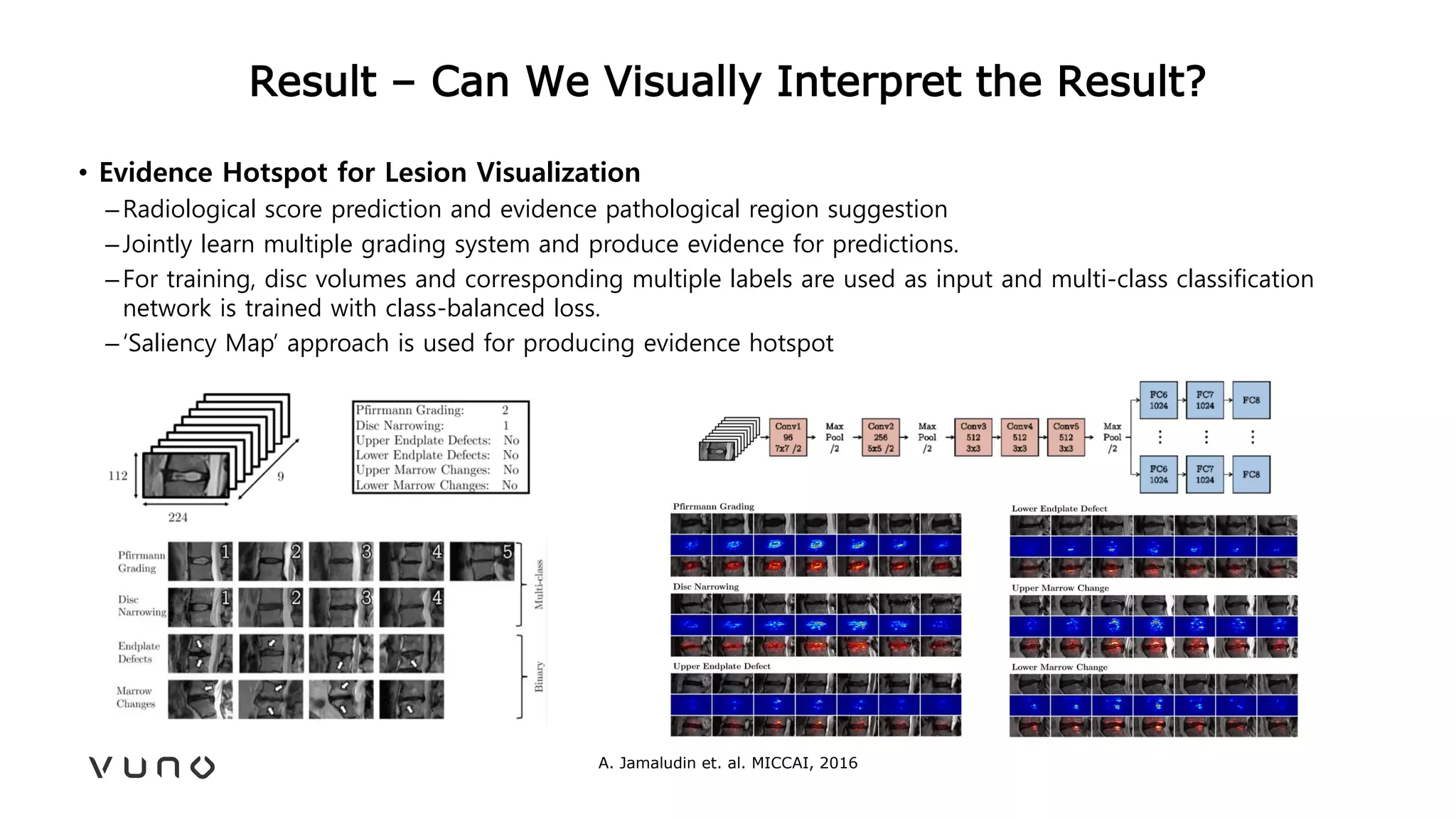 Result – Can We Visually Interpret the Result?
• Evidence Hotspot for Lesion Visualization
–Radiological score prediction and evidence pathological region suggestion
–Jointly learn multiple grading system and produce evidence for predictions.
–For training, disc volumes and corresponding multiple labels are used as input and multi-class classification
network is trained with class-balanced loss.
–‘Saliency Map’ approach is used for producing evidence hotspot
A. Jamaludin et. al. MICCAI, 2016
 
