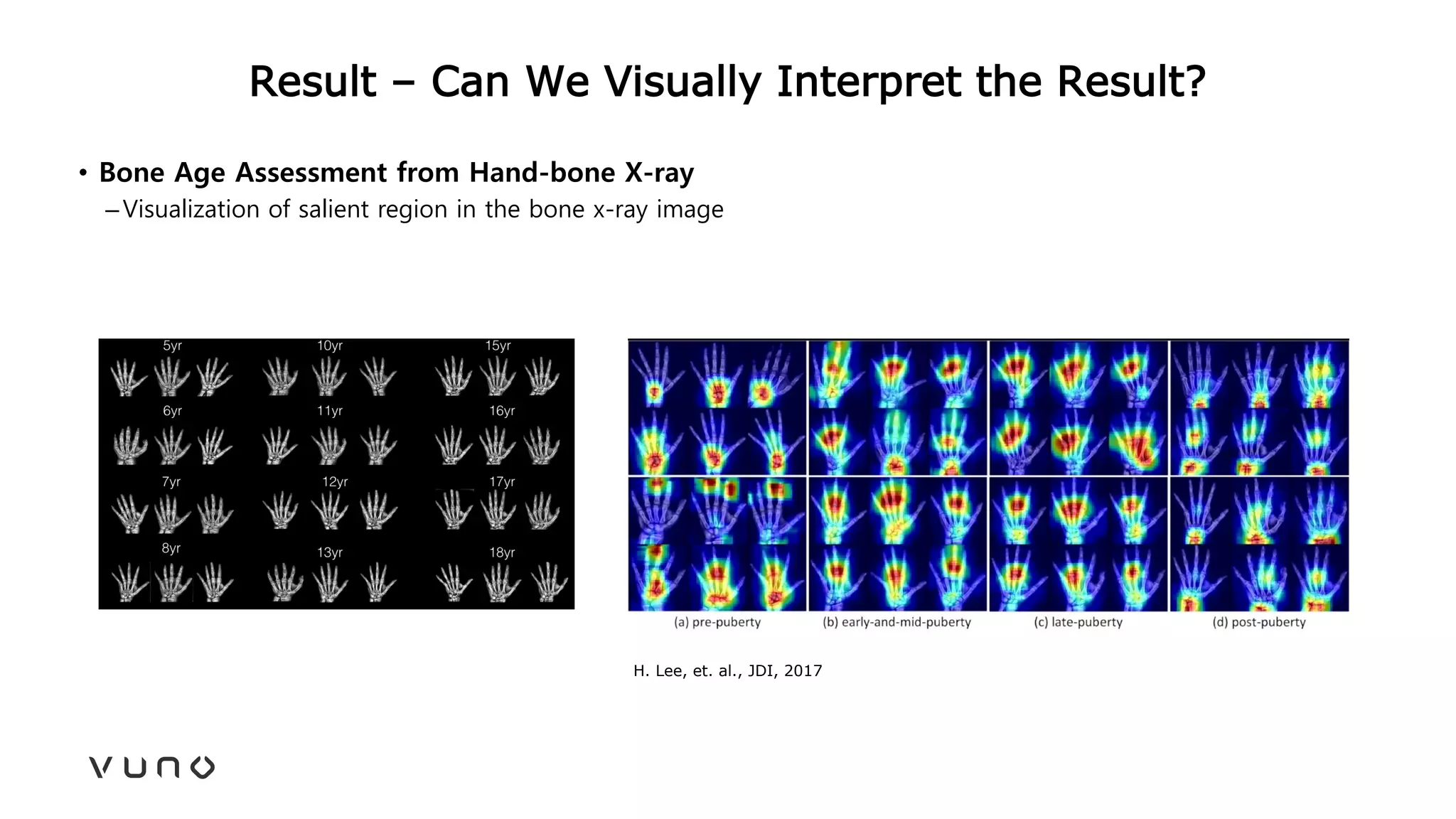 Result – Can We Visually Interpret the Result?
• Bone Age Assessment from Hand-bone X-ray
–Visualization of salient region in the bone x-ray image
H. Lee, et. al., JDI, 2017
 