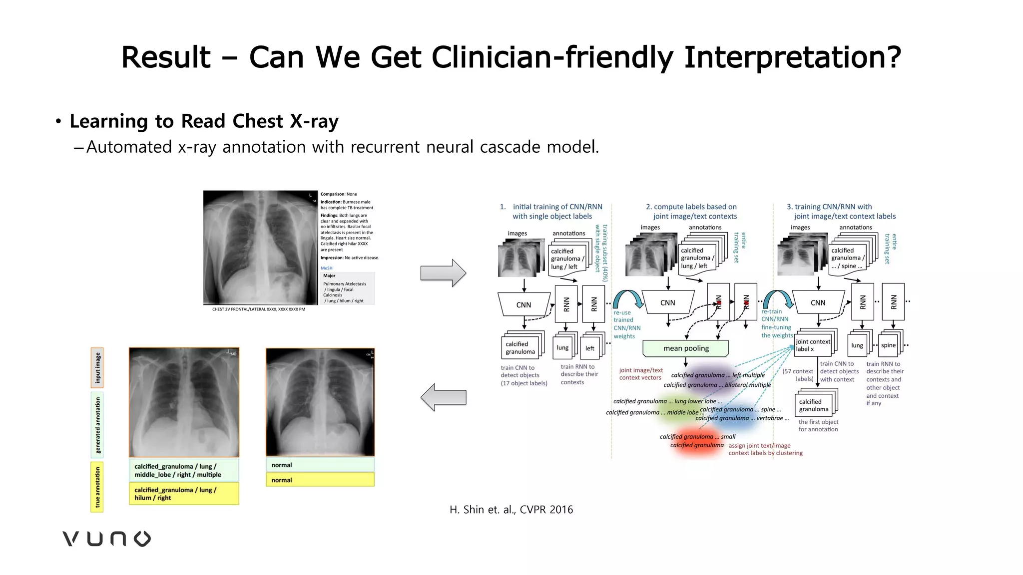 Result – Can We Get Clinician-friendly Interpretation?
• Learning to Read Chest X-ray
–Automated x-ray annotation with recurrent neural cascade model.
H. Shin et. al., CVPR 2016
 