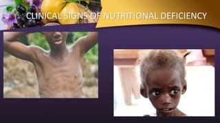 CLINICAL SIGNS OF NUTRITIONAL DEFICIENCY
 