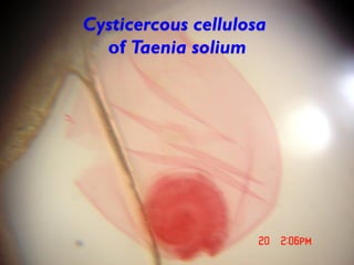 Cysticercous cellulosa
of Taenia solium
 