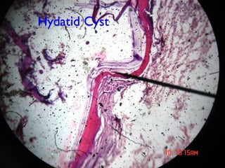 Hydatid Cyst
 