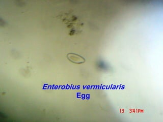Enterobius vermicularis
Egg
 