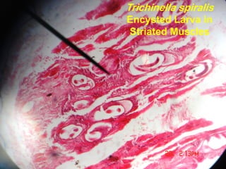 Trichinella spiralis
Encysted Larva in
Striated Muscles
 