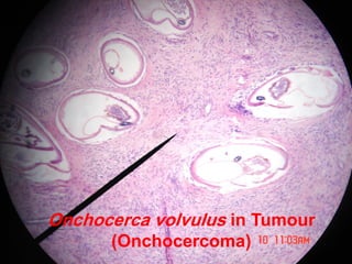 Onchocerca volvulus in Tumour
(Onchocercoma)
 