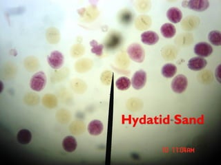 Hydatid Sand
 