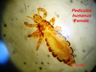 Pediculus
humanus
Female
 