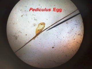 Pediculus Egg
 