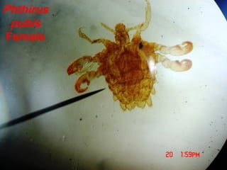 Phthirus
pubis
Female
 