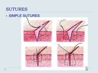 SUTURES
   SIMPLE SUTURES
 