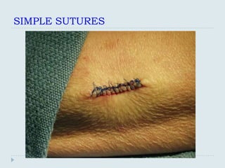 SIMPLE SUTURES
 