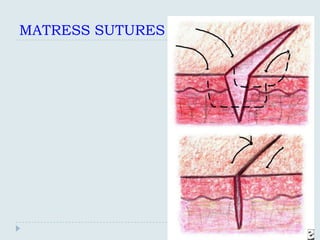 MATRESS SUTURES
 