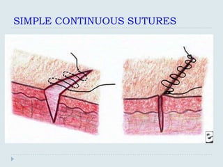 SIMPLE CONTINUOUS SUTURES
 