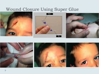 Wound Closure Using Super Glue
 
