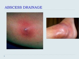 ABSCESS DRAINAGE
 