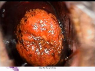 One Day hysterectomy
 