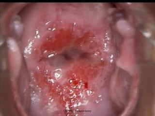 One Day hysterectomy
 