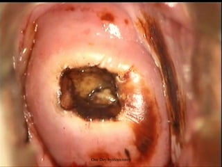 One Day hysterectomy
 