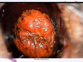 One Day hysterectomy
 