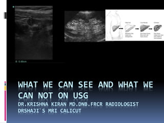 WHAT WE CAN SEE AND WHAT WE
CAN NOT ON USG
DR.KRISHNA KIRAN MD.DNB.FRCR RADIOLOGIST
DRSHAJI`S MRI CALICUT
 