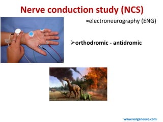 Nerve conduction study (NCS)
=electroneurography (ENG)
www.varganeuro.com
orthodromic - antidromic
 
