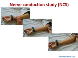 Nerve conduction study (NCS)
www.varganeuro.com
 