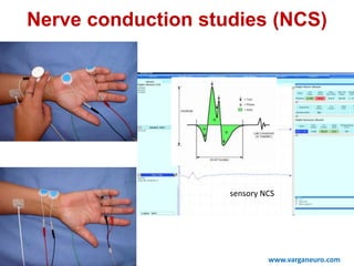 Nerve conduction studies (NCS)
motor NCS
sensory NCS
www.varganeuro.com
 