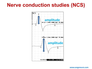 amplitude
amplitude
Nerve conduction studies (NCS)
www.varganeuro.com
 